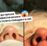 Пострадавший от пули нос мужчины восстановили нижегородские врачи - фото 1 - vGorodeN.Ru